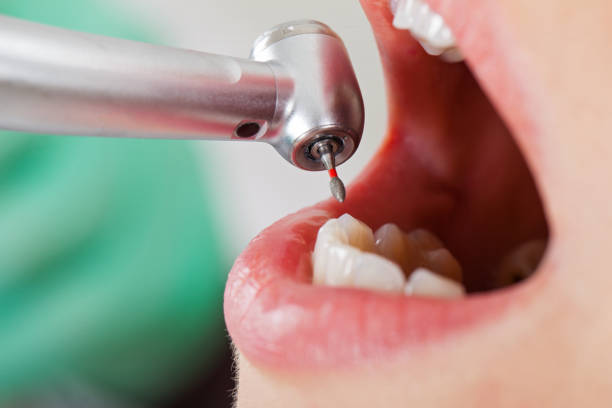 Best Emergency Wisdom Teeth Removal in Vla Park, IL